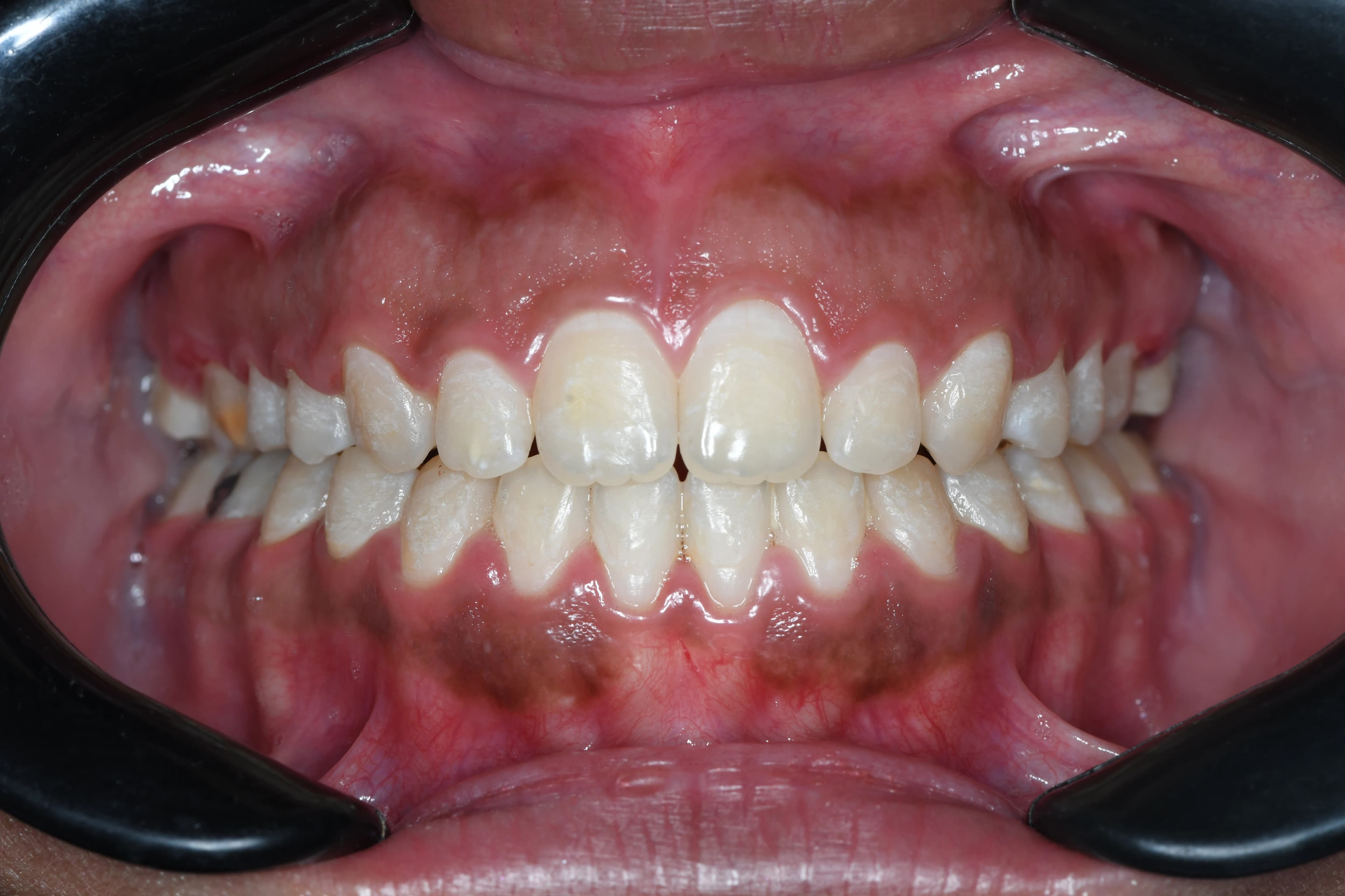 بعد - صورة قبل وبعد حشو الأسنان التجميلي – إصلاح التسوس وتحسين شكل السن باستخدام حشوات بلون طبيعي في توث ميت، أفضل عيادة أسنان في المعادي، احجز الآن مع أفضل دكتور تجميل