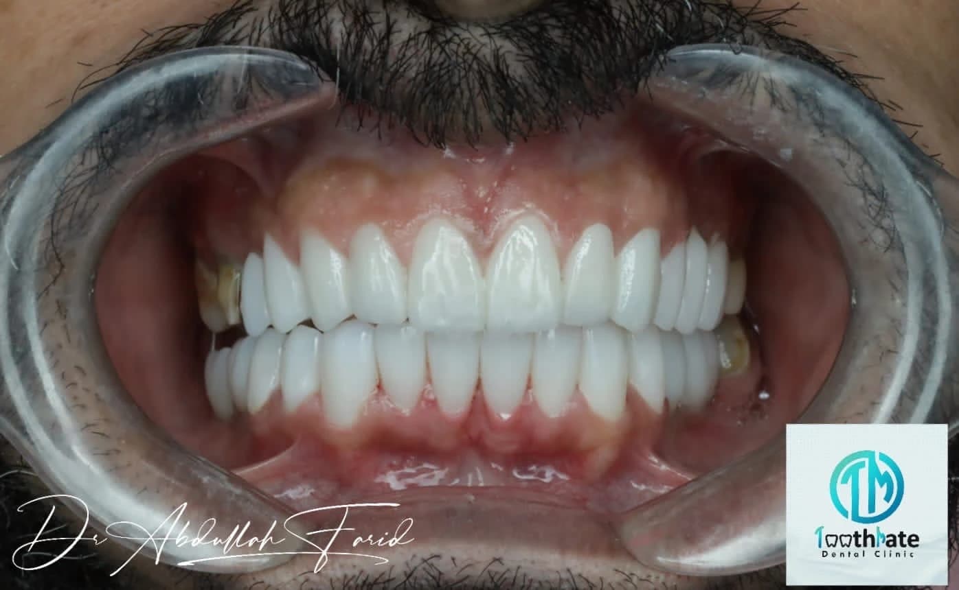 بعد - صورة قبل وبعد تبييض الأسنان – الفرق في درجة اللون واللمعان باستخدام تقنية الليزر الحديثة في توث ميت، أفضل عيادة تبييض أسنان في المعادي، احجز معنا لتفتيح ابتسامتك