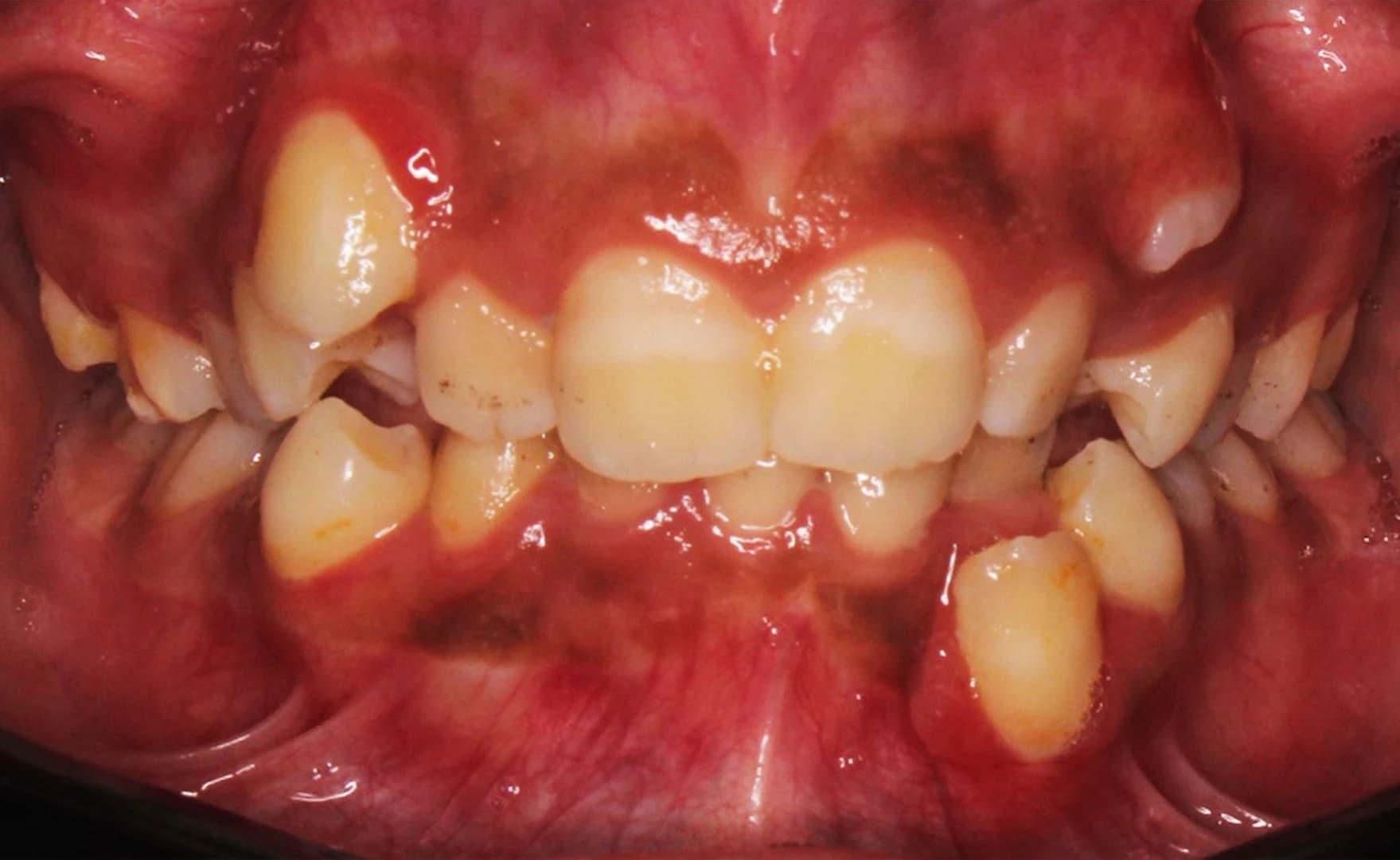 قبل - صورة قبل وبعد تقويم الأسنان – الفرق في استقامة الأسنان وتحسين تطابق الفك باستخدام أجهزة حديثة في أفضل عيادة أسنان في المعادي توث ميت، احجز معنا الآن مع أفضل دكتور تقويم