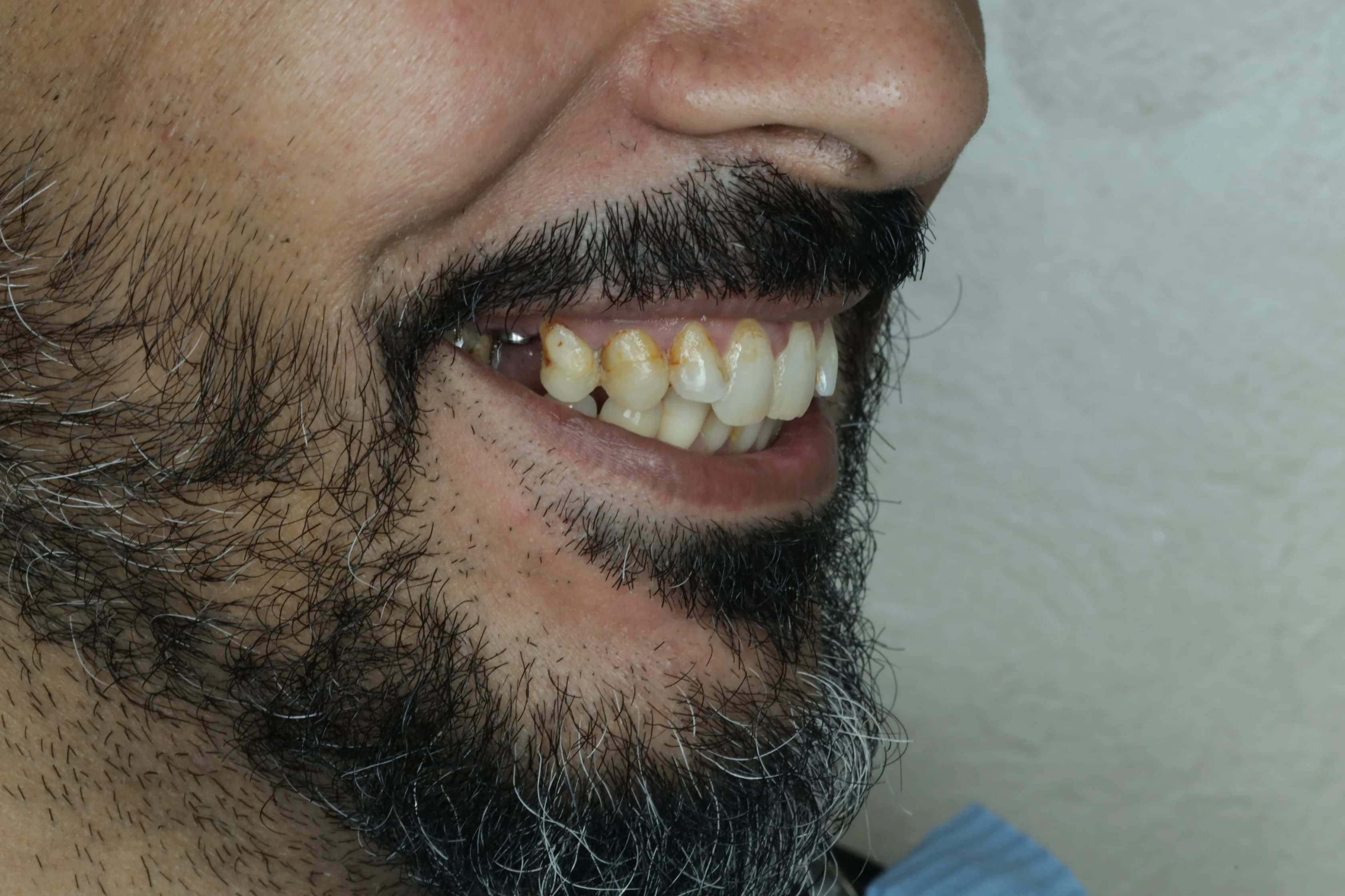 قبل - صورة قبل وبعد تركيب فينير الأسنان – تُبرز بياض الأسنان وتناسقها للحصول على ابتسامة هوليود جذابة في توث ميت، أفضل عيادة تجميل أسنان في المعادي، احجز الآن