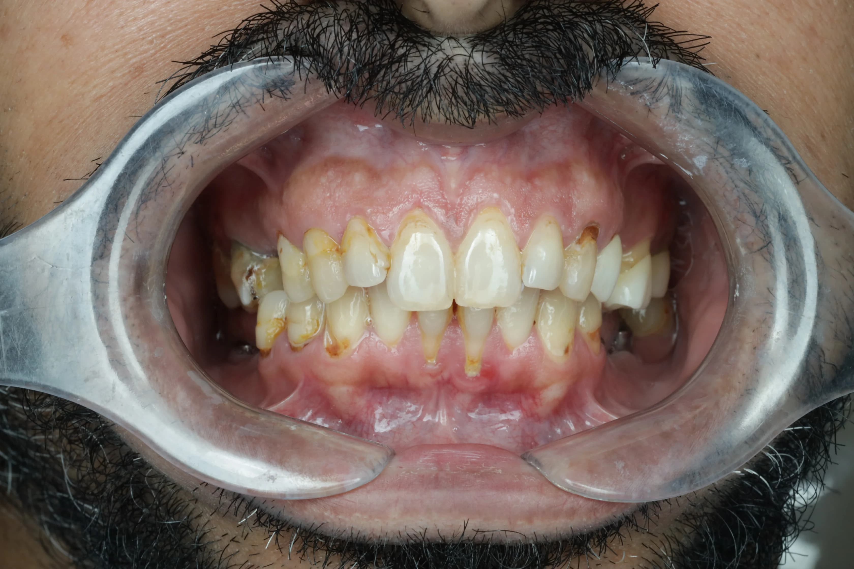 قبل - صورة قبل وبعد تبييض الأسنان – الفرق في درجة اللون واللمعان باستخدام تقنية الليزر الحديثة في توث ميت، أفضل عيادة تبييض أسنان في المعادي، احجز معنا لتفتيح ابتسامتك