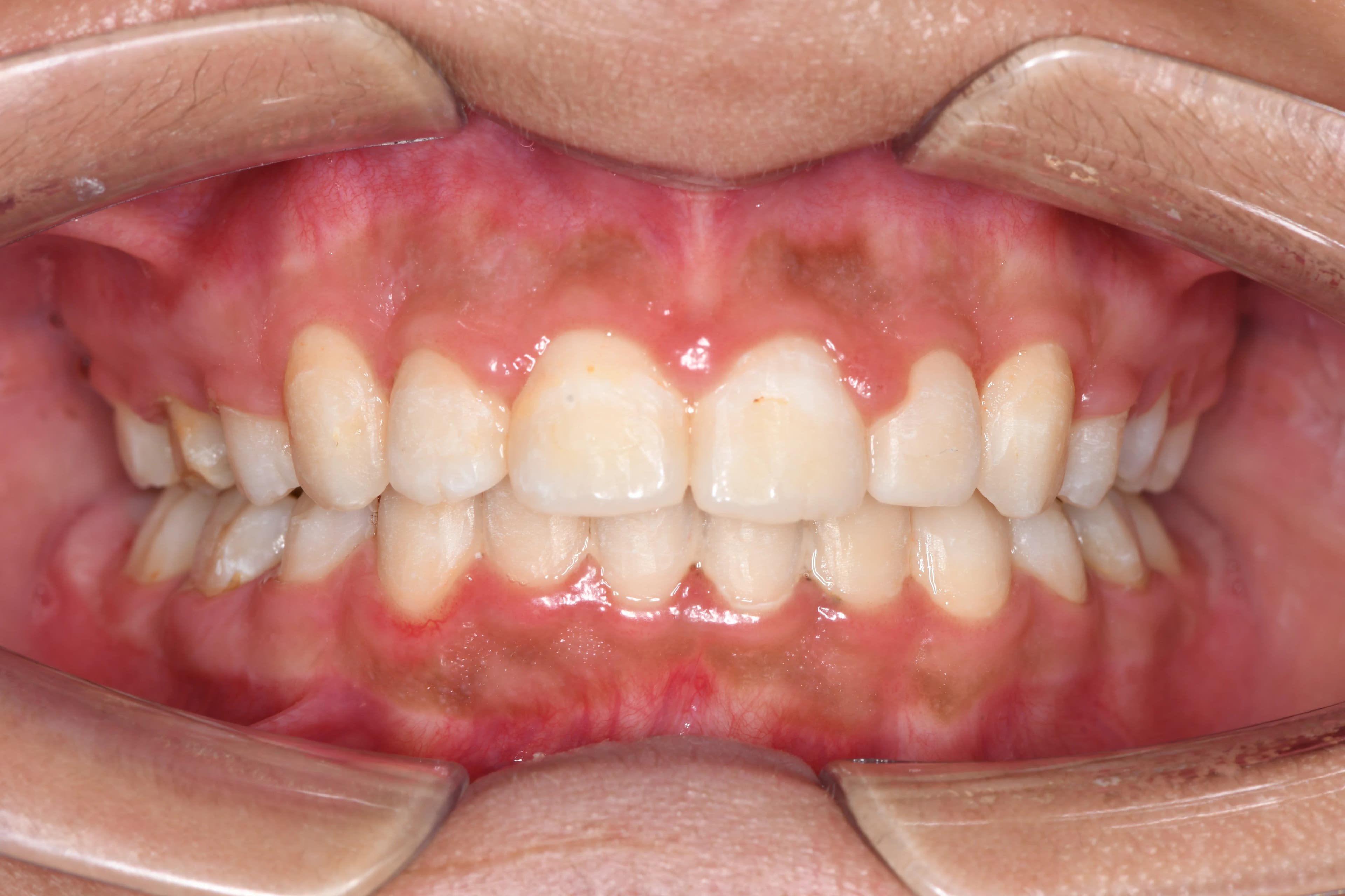 بعد - صورة قبل وبعد تقويم الأسنان – الفرق في استقامة الأسنان وتحسين تطابق الفك باستخدام أجهزة حديثة في أفضل عيادة أسنان في المعادي توث ميت، احجز معنا الآن مع أفضل دكتور تقويم